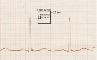 How to interpret ECG waves: recommendations and general information