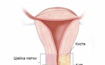 How to detect hidden pathologies - symptoms of uterine fibroids and ovarian cysts